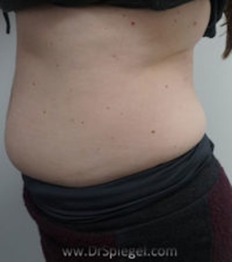 Fat Freezing Before & After Gallery - Patient 367790 - Image 1