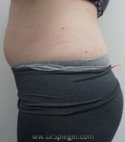 Fat Freezing Before & After Gallery - Patient 367790 - Image 2