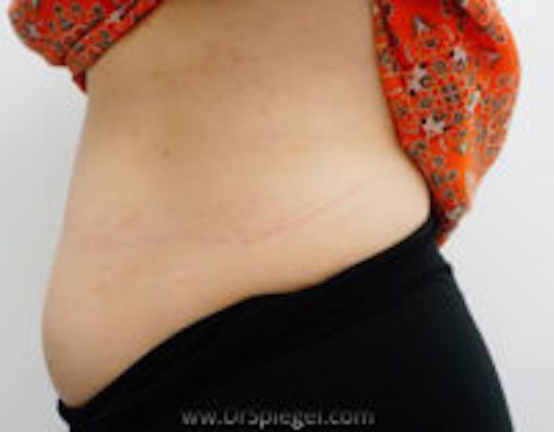 Fat Freezing Before & After Gallery - Patient 856473 - Image 1