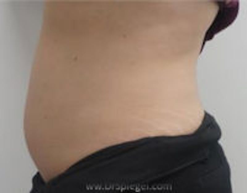 Fat Freezing Before & After Gallery - Patient 856473 - Image 2