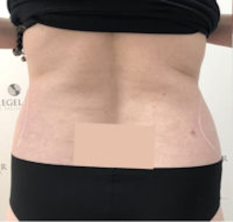 Fat Freezing Before & After Gallery - Patient 124630 - Image 1