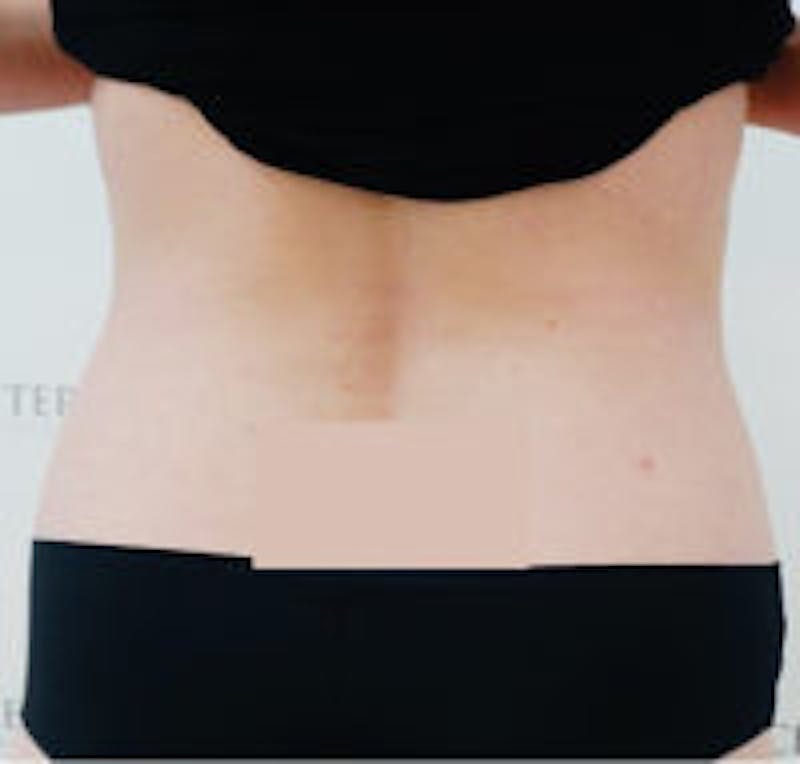 Fat Freezing Before & After Gallery - Patient 124630 - Image 2
