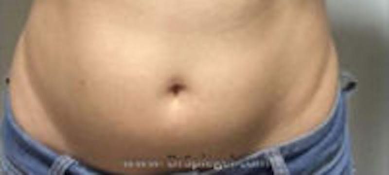 Fat Freezing Before & After Gallery - Patient 161530 - Image 1
