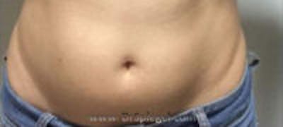 Fat Freezing Before & After Gallery - Patient 161530 - Image 1