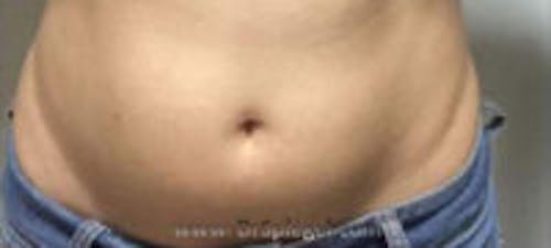 Fat Freezing Before & After Gallery - Patient 161530 - Image 1