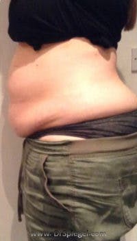 Fat Freezing Before & After Gallery - Patient 283349 - Image 1