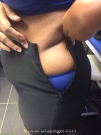 Fat Freezing Before & After Gallery - Patient 176494 - Image 1