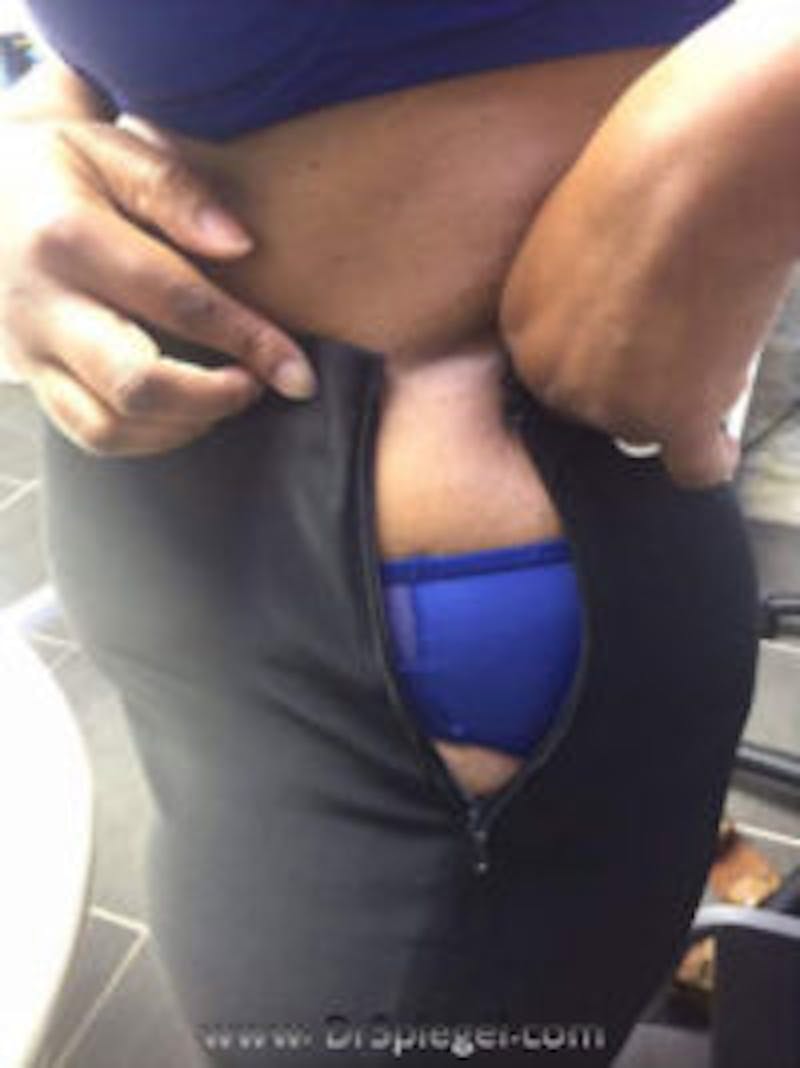 Fat Freezing Before & After Gallery - Patient 176494 - Image 2