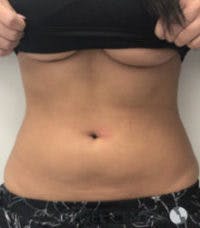 Fat Freezing Before & After Gallery - Patient 840919 - Image 1
