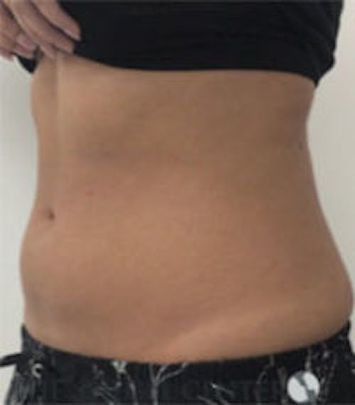 Fat Freezing Before & After Gallery - Patient 840919 - Image 3