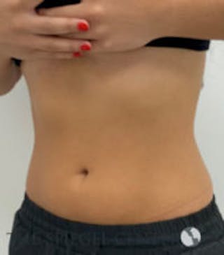 Fat Freezing Before & After Gallery - Patient 840919 - Image 4