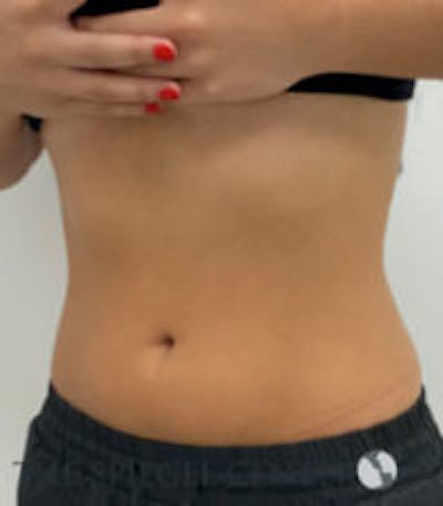 Fat Freezing Before & After Gallery - Patient 840919 - Image 4