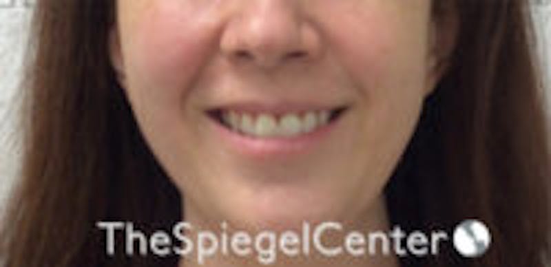 Gummy Smile Botox Before & After Gallery - Patient 398213 - Image 2