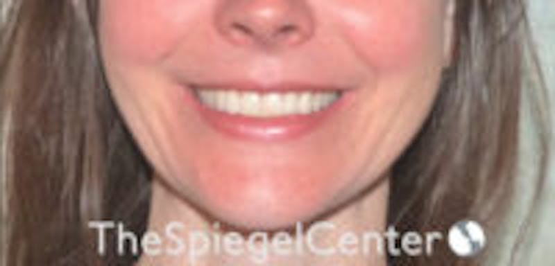 Gummy Smile Botox Before & After Gallery - Patient 228471 - Image 2