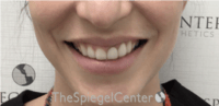 Gummy Smile Botox Before & After Gallery - Patient 310096 - Image 1