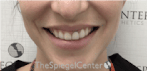 Gummy Smile Botox Before & After Gallery - Patient 310096 - Image 1