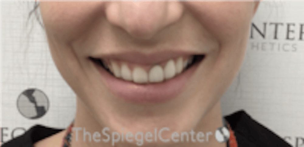 Gummy Smile Correction