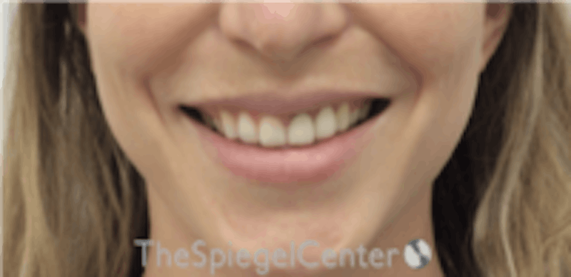 Gummy Smile Botox Before & After Gallery - Patient 310096 - Image 2
