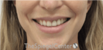 Gummy Smile Botox Before & After Gallery - Patient 310096 - Image 2