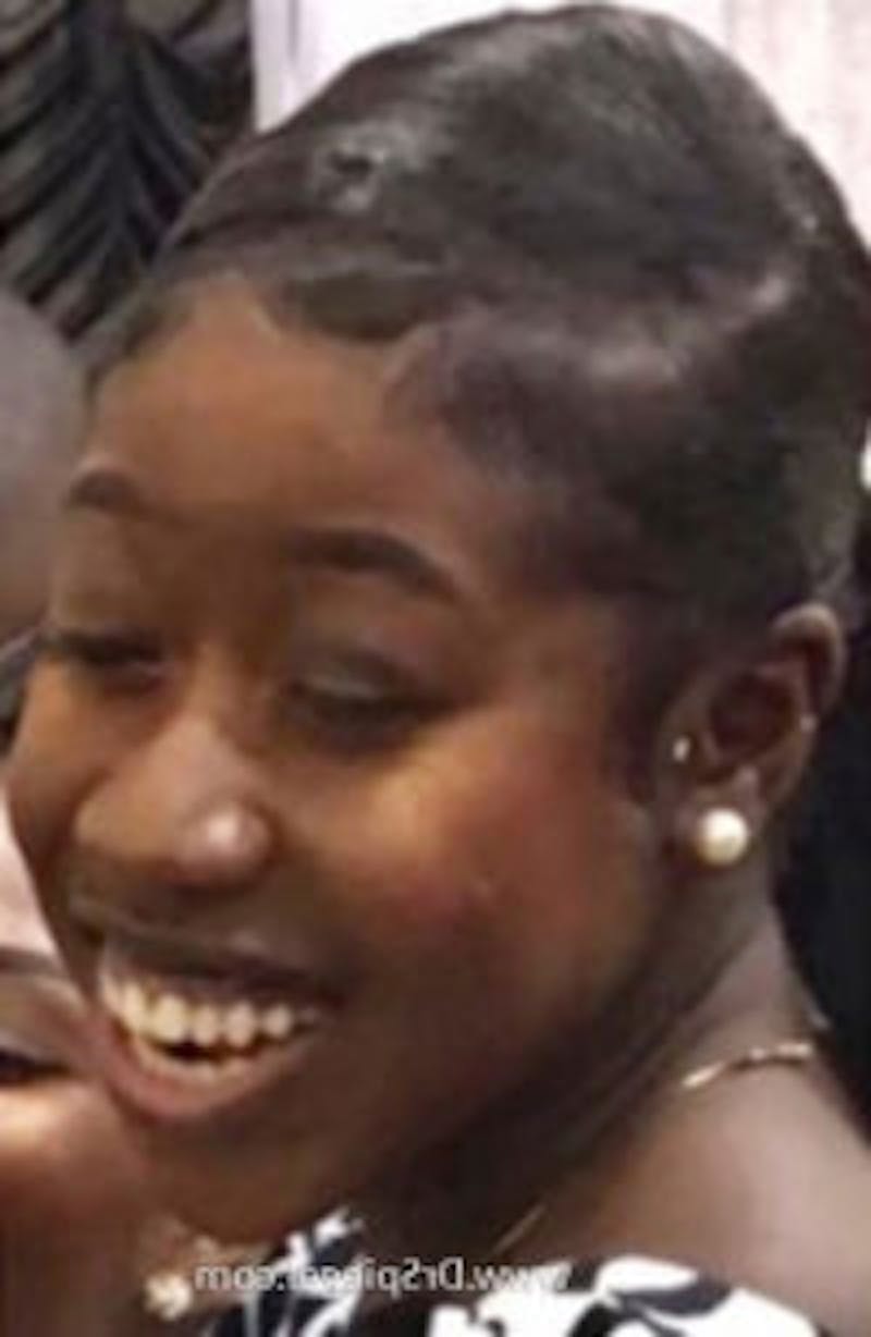 Gummy Smile Botox Before & After Gallery - Patient 734873 - Image 1