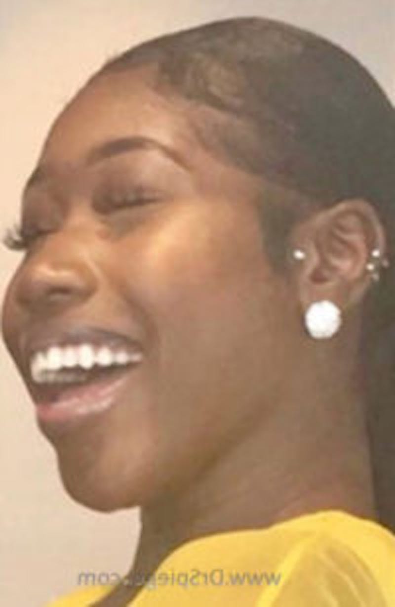 Gummy Smile Botox Before & After Gallery - Patient 734873 - Image 2