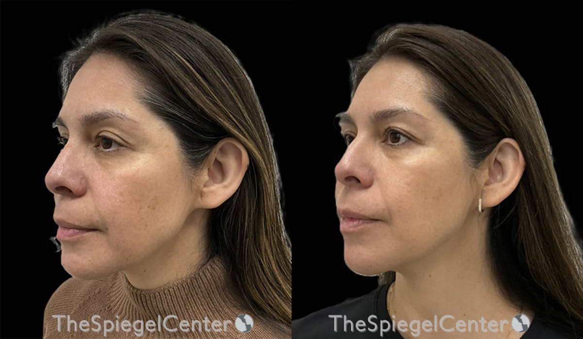 IPL / Intense Pulse Light Before & After Gallery - Patient 255785 - Image 1