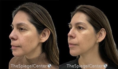 IPL / Intense Pulse Light Before & After Gallery - Patient 255785 - Image 1
