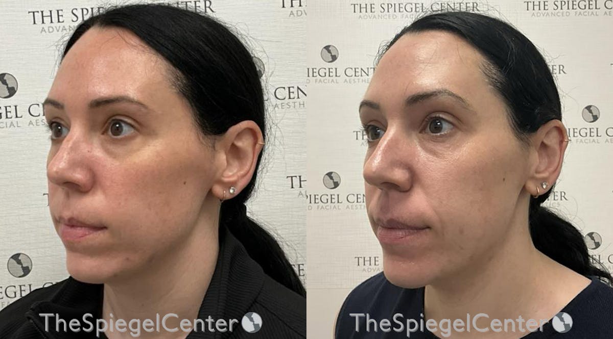 IPL / Intense Pulse Light Before & After Gallery - Patient 314878 - Image 1