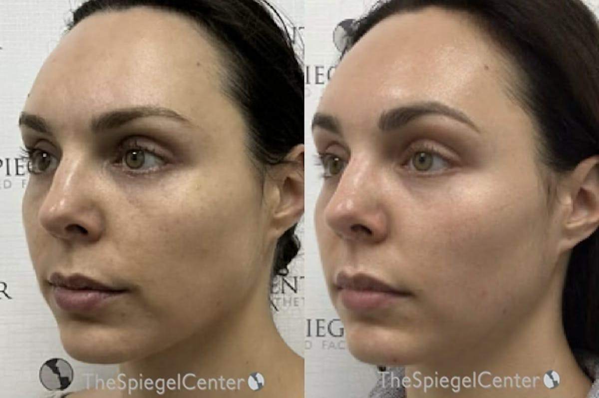 IPL / Intense Pulse Light Before & After Gallery - Patient 780919 - Image 1