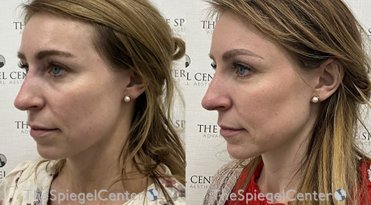 IPL / Intense Pulse Light Before & After Gallery - Patient 585462 - Image 1
