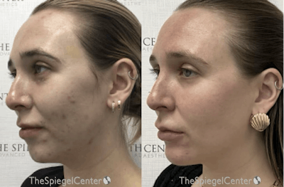 IPL / Intense Pulse Light Before & After Gallery - Patient 140152 - Image 1
