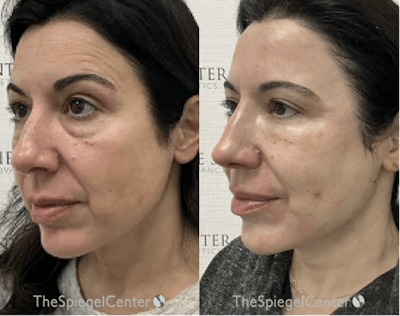 IPL / Intense Pulse Light Before & After Gallery - Patient 233952 - Image 1