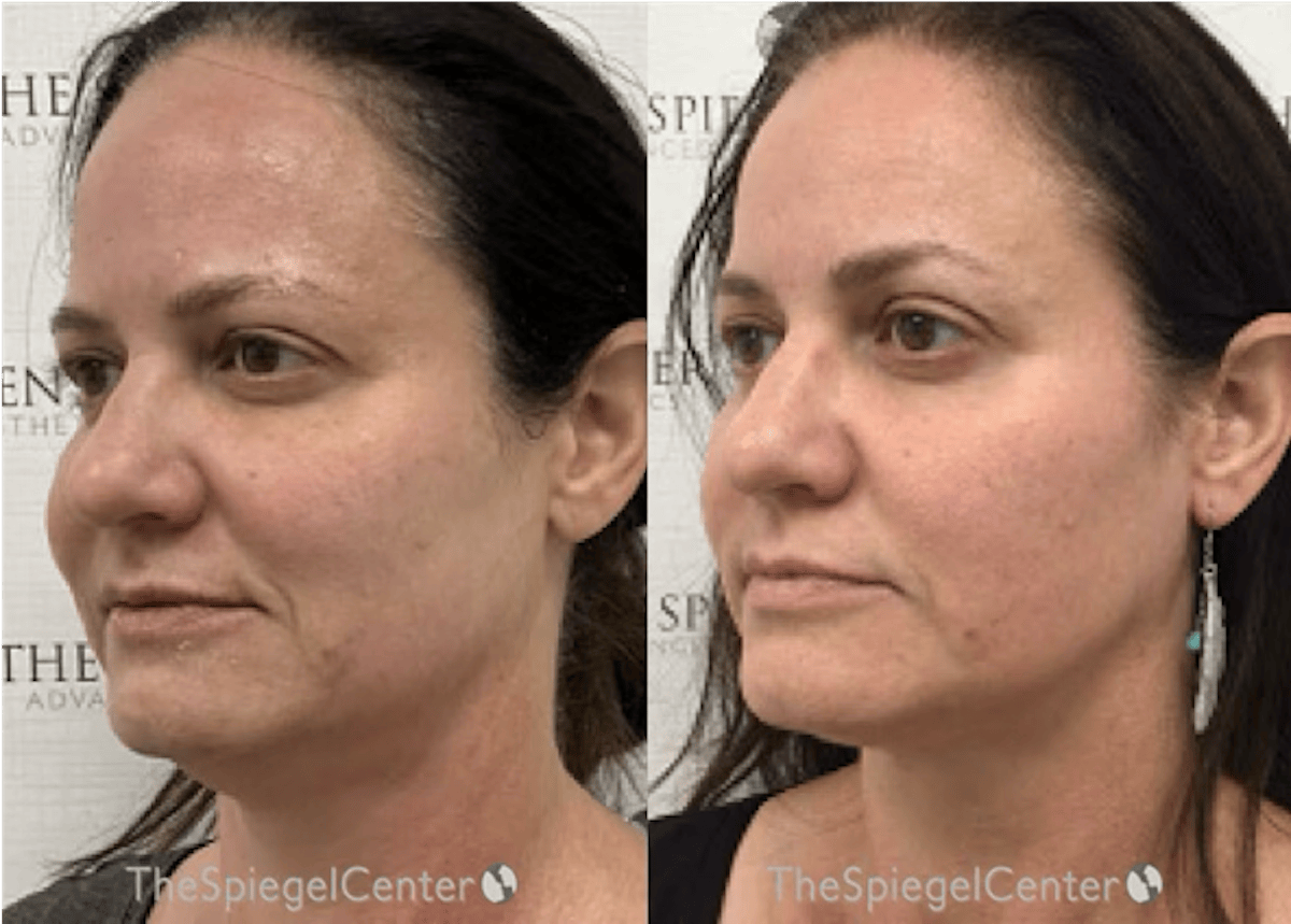 IPL / Intense Pulse Light Before & After Gallery - Patient 409750 - Image 1