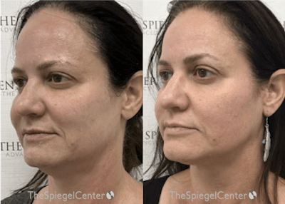 IPL / Intense Pulse Light Before & After Gallery - Patient 409750 - Image 1