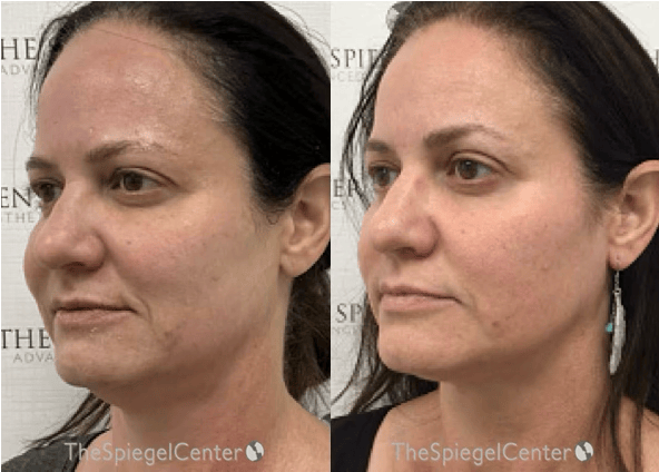 IPL / Intense Pulse Light Before & After Gallery - Patient 409750 - Image 1