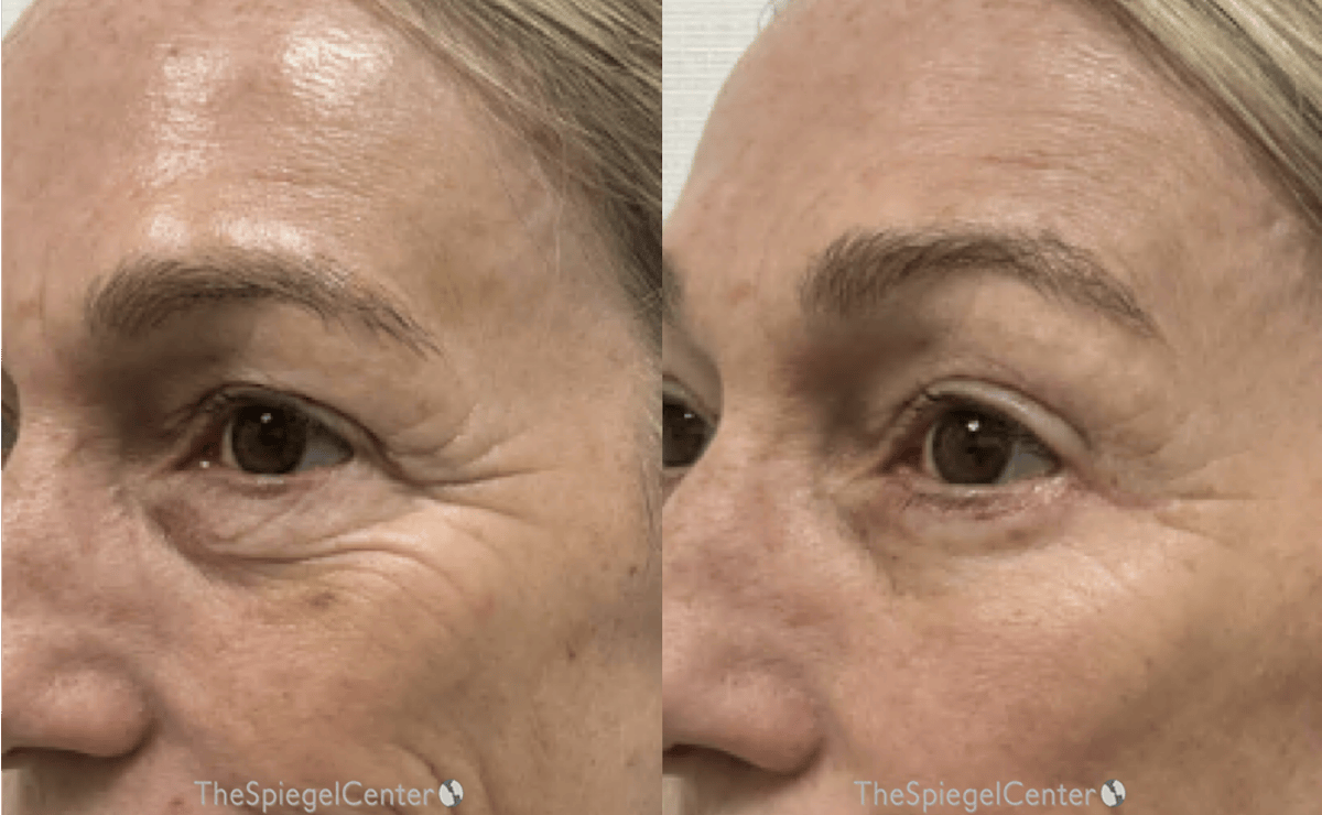 IPL / Intense Pulse Light Before & After Gallery - Patient 220378 - Image 1