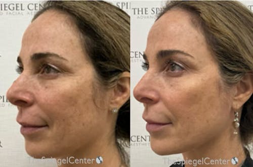 IPL / Intense Pulse Light Before & After Gallery - Patient 338316 - Image 1
