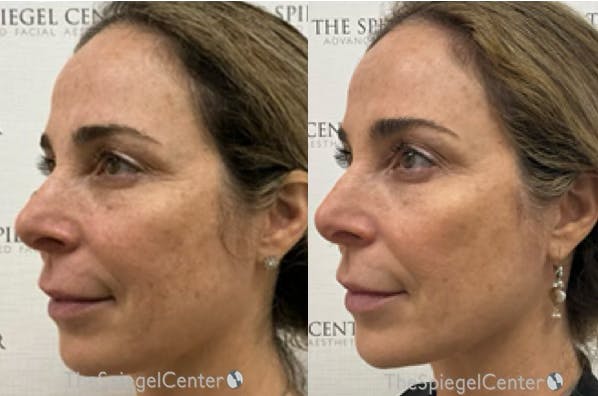 IPL / Intense Pulse Light Before & After Gallery - Patient 338316 - Image 1