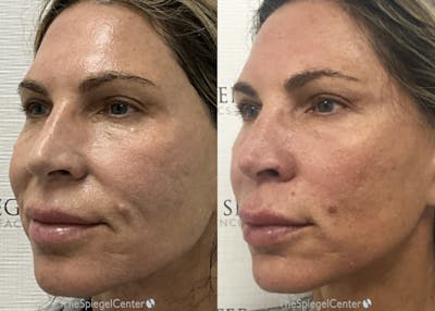 IPL / Intense Pulse Light Before & After Gallery - Patient 119224 - Image 1