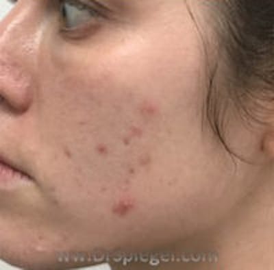 IPL / Intense Pulse Light Before & After Gallery - Patient 151722 - Image 1