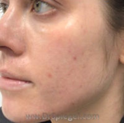 IPL / Intense Pulse Light Before & After Gallery - Patient 151722 - Image 2