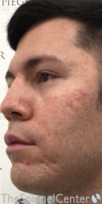 IPL / Intense Pulse Light Before & After Gallery - Patient 167161 - Image 1