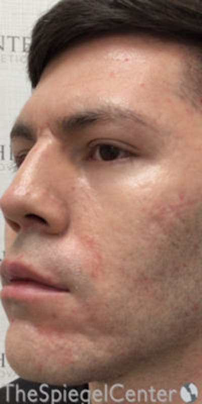 IPL / Intense Pulse Light Before & After Gallery - Patient 167161 - Image 2