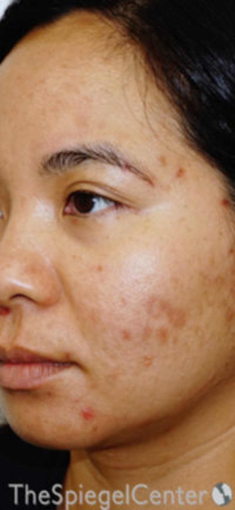 IPL / Intense Pulse Light Before & After Gallery - Patient 154968 - Image 1