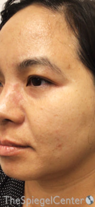 IPL / Intense Pulse Light Before & After Gallery - Patient 154968 - Image 2