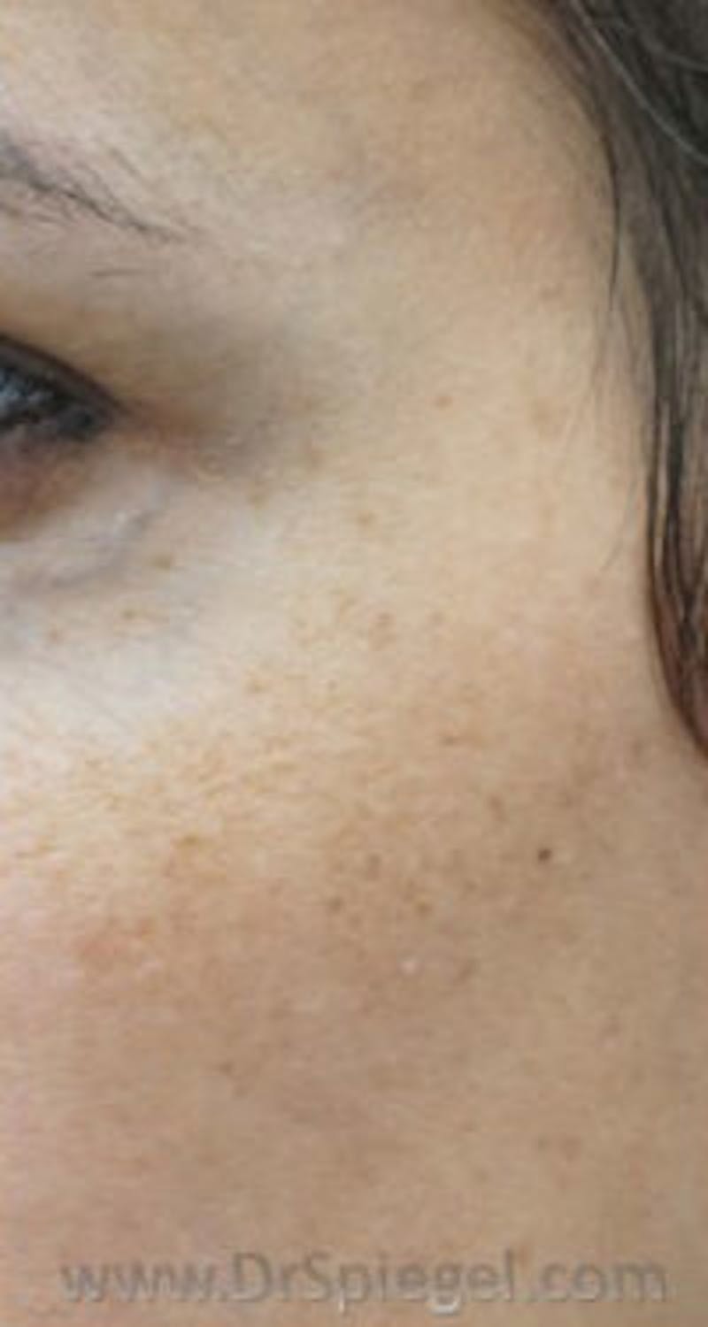 IPL / Intense Pulse Light Before & After Gallery - Patient 112879 - Image 1