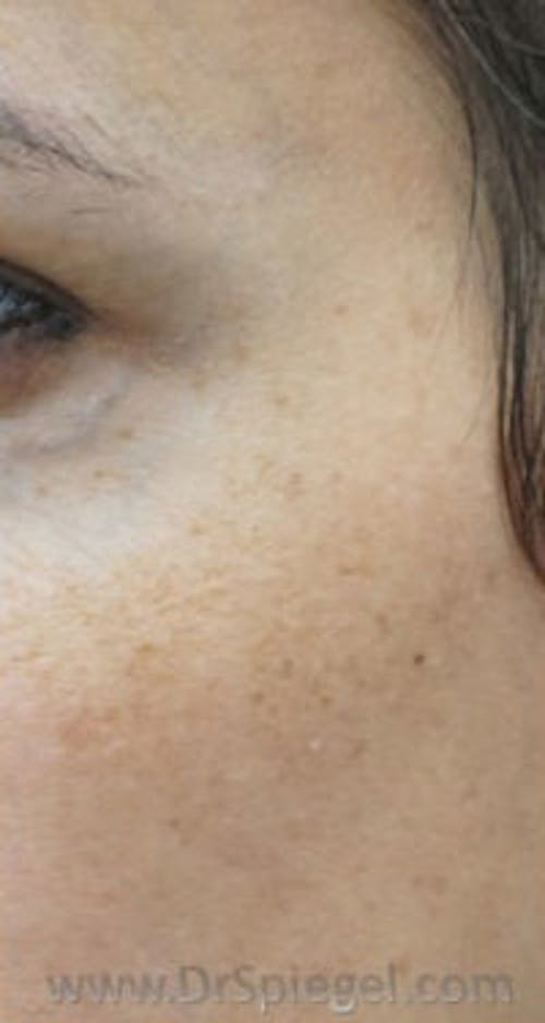 IPL / Intense Pulse Light Before & After Gallery - Patient 112879 - Image 1
