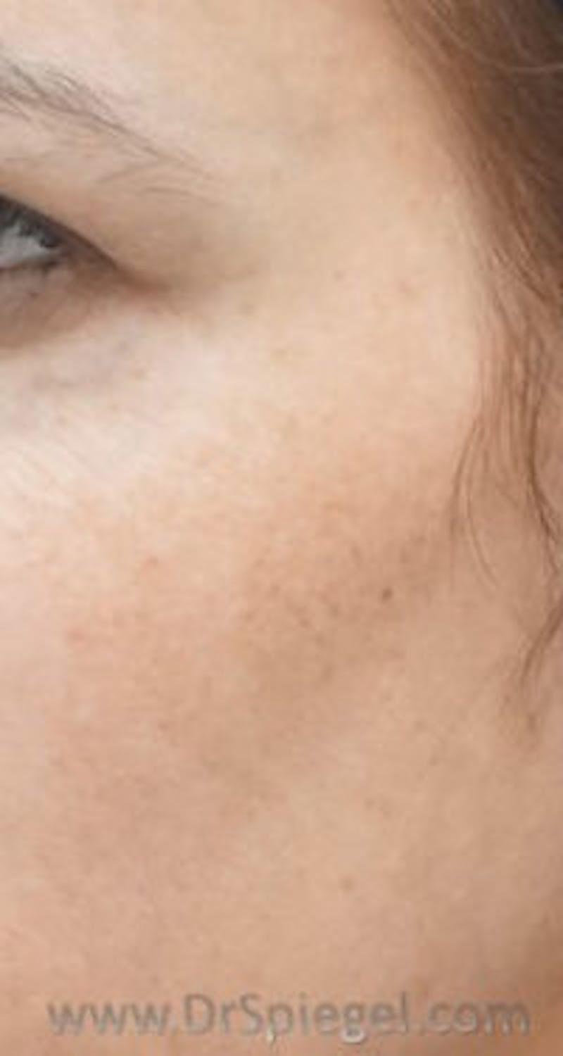 IPL / Intense Pulse Light Before & After Gallery - Patient 112879 - Image 2