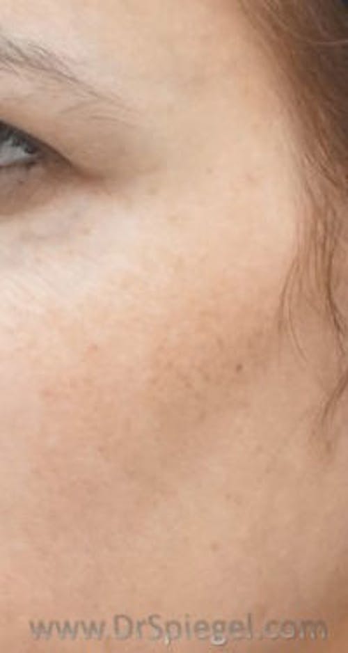 IPL / Intense Pulse Light Before & After Gallery - Patient 112879 - Image 2
