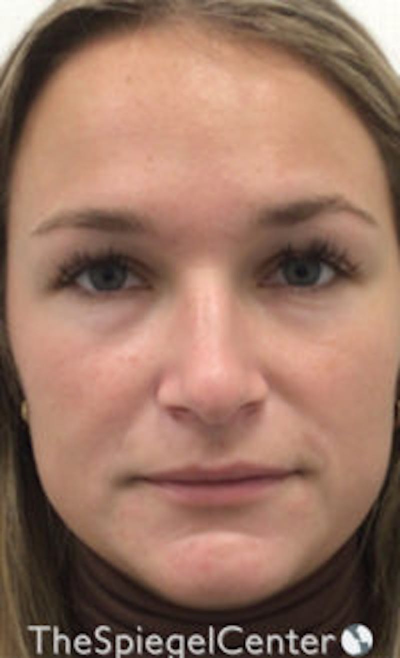 IPL / Intense Pulse Light Before & After Gallery - Patient 373506 - Image 1